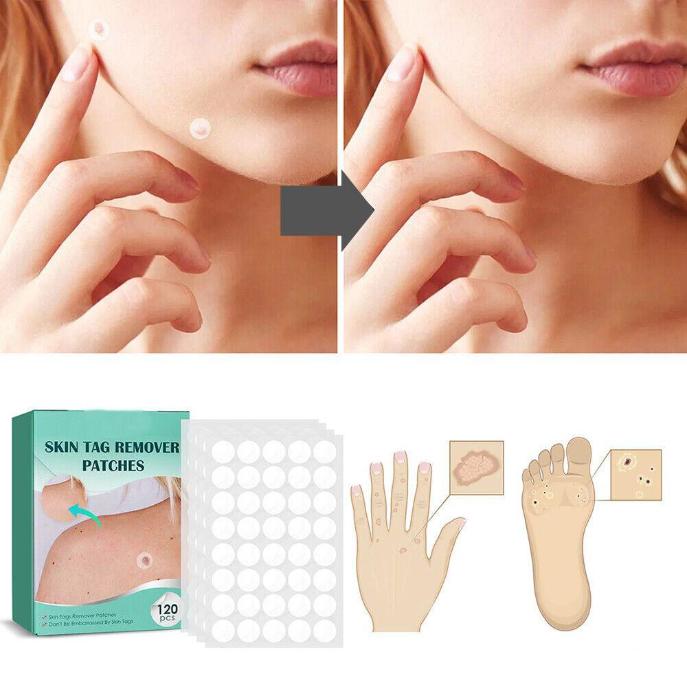 SkinClear Skin Tag & Blemish Patches - Pack of 120
