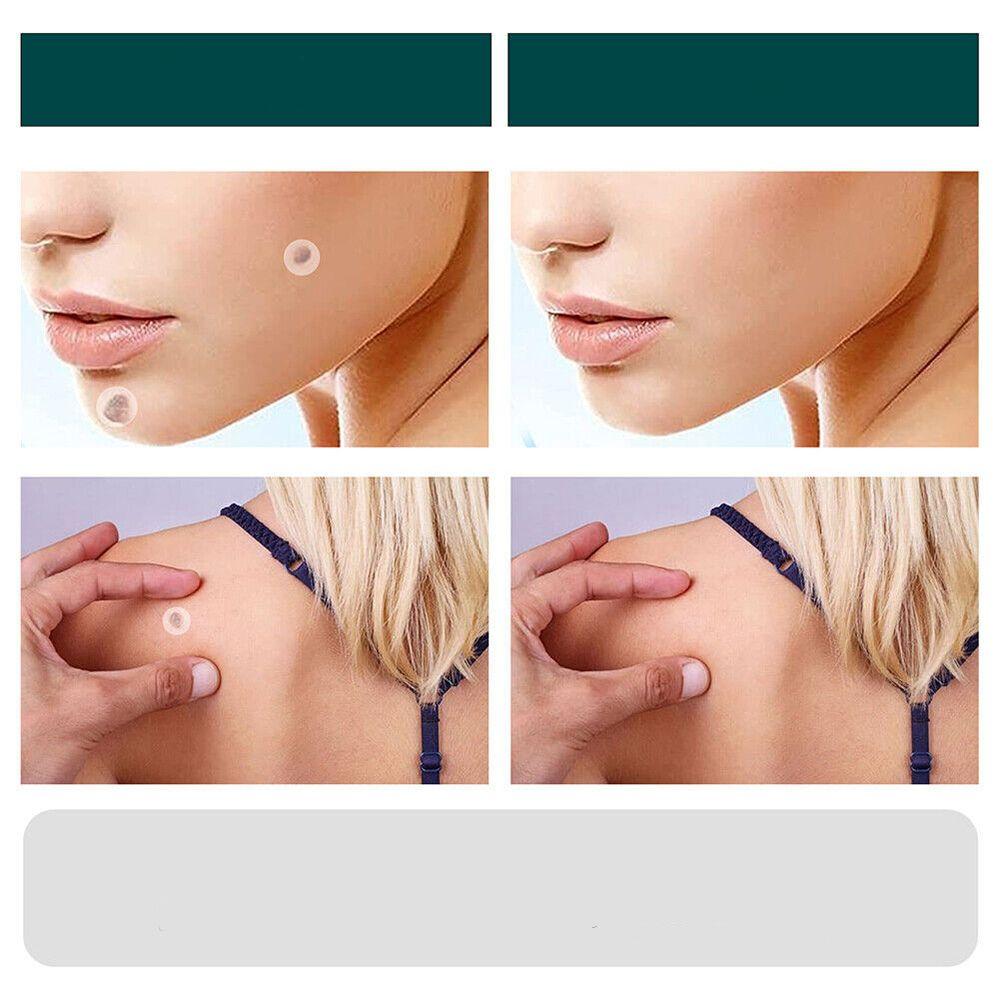 SkinClear Skin Tag & Blemish Patches - Pack of 120