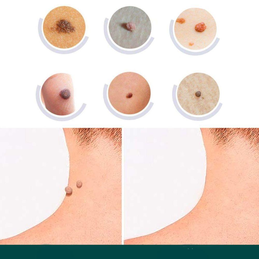 SkinClear Skin Tag & Blemish Patches - Pack of 120